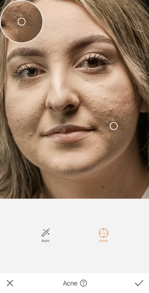 Rosto de uma mulher com marcas de espinha. 
