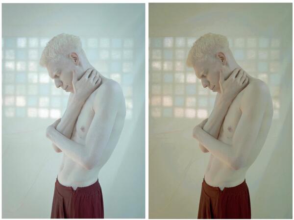 Homem albino com a mão no pescoço 
